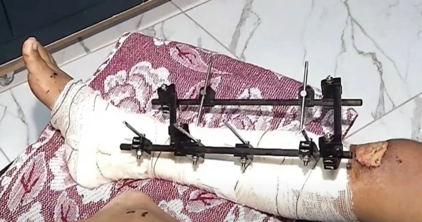 Blogueiro foi submetido a cirurgia na perna após o acidente