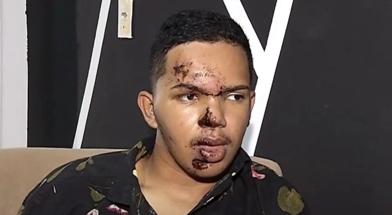 Rosto do blogueiro Lokinho após o acidente