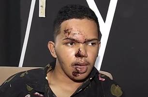 Rosto do blogueiro Lokinho após o acidente (Foto: Reprodução) Rosto do blogueiro Lokinho após o acidente (Foto: Reprodução)