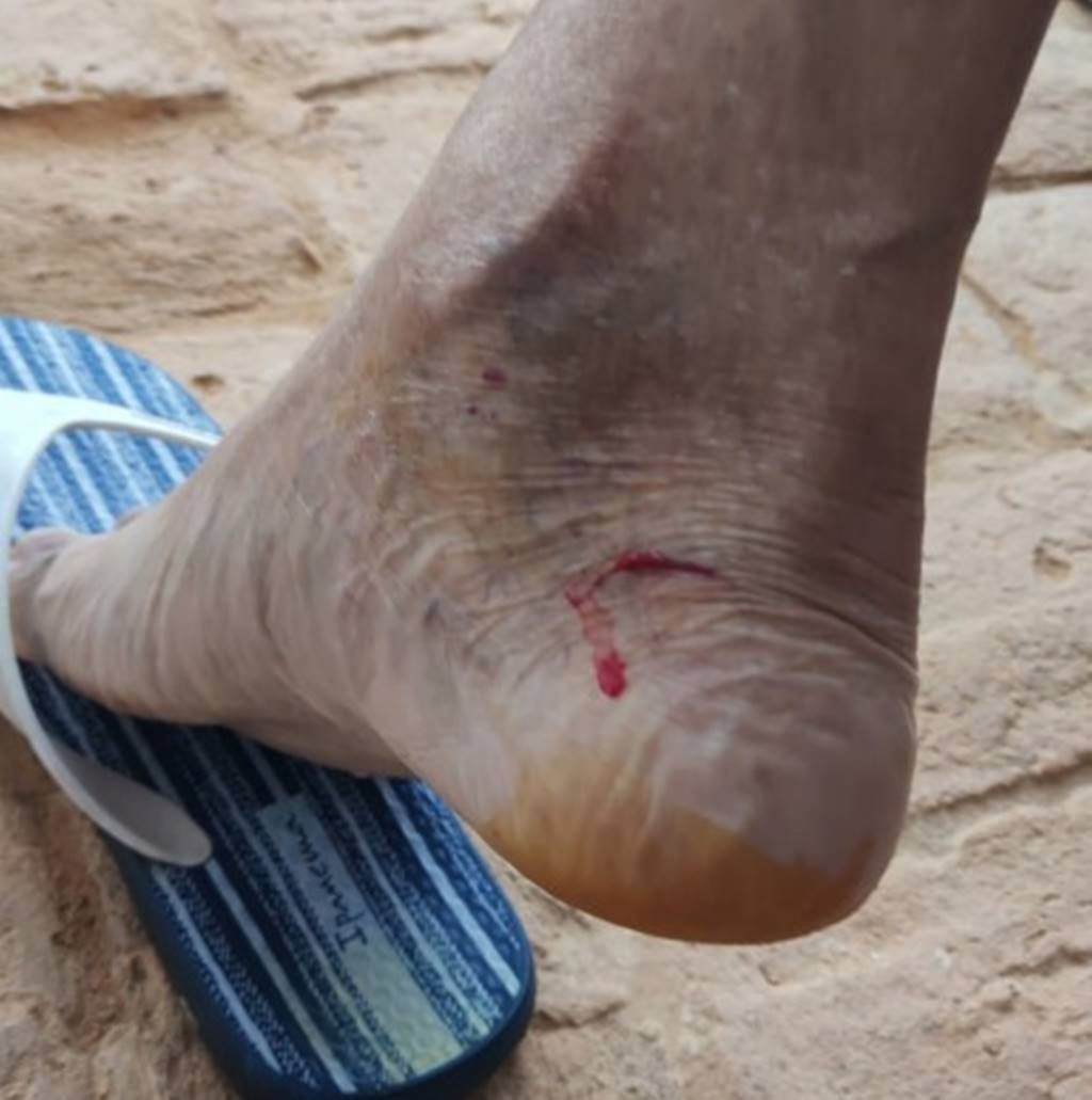 Ferimento causado pelo cachorro de Bianca ao senhor Hoziel