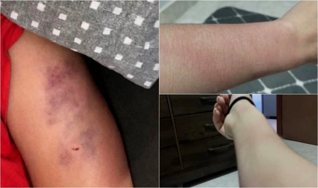 Jovem é agredida por ex-companheiro e sofre tentativa de feminicídio