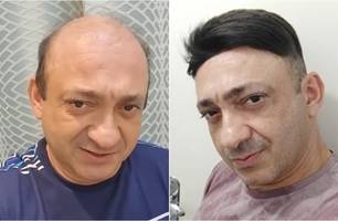 Beto Rego atualmente e quando testou uma prótese capilar (Foto: Reprodução) Beto Rego atualmente e quando testou uma prótese capilar (Foto: Reprodução)