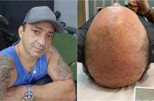 Beto Rego atualiza sobre tratamento contra a 'carequice' (Foto: Reprodução/Redes sociais) Beto Rego atualiza sobre tratamento contra a 'carequice' (Foto: Reprodução/Redes sociais)