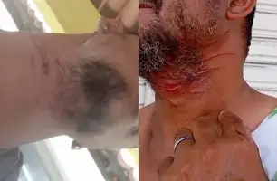 Arame farpado em estrada deixa motociclistas com ferimentos no pescoço em Pio IX (Foto: Reprodução) Arame farpado em estrada deixa motociclistas com ferimentos no pescoço em Pio IX (Foto: Reprodução)