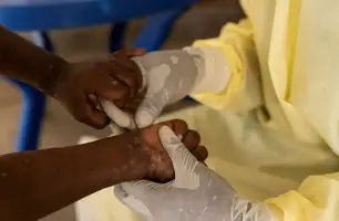 Mpox: conheça sintomas e tire principais dúvidas sobre a doença (Foto: Arlette Nashizi)