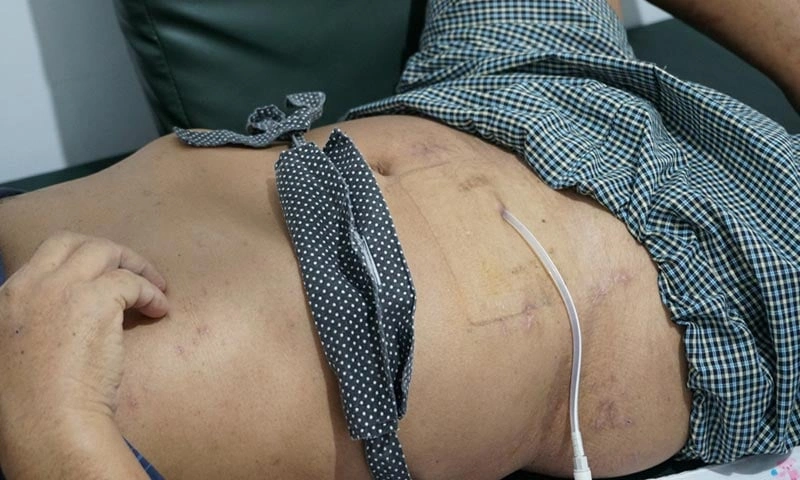 Diálise Peritoneal - Usada em casos de insuficiência renal crônica terminal