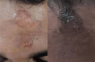 Mistério : Fiéis relatam queimaduras na testa após missa da quarta-feira de cinzas (Foto: Reprodução) Mistério : Fiéis relatam queimaduras na testa após missa da quarta-feira de cinzas (Foto: Reprodução)