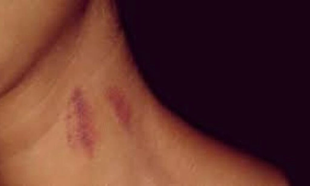 Mulher é diagnosticado com AVC após levar um chupão no pescoço; entenda o caso