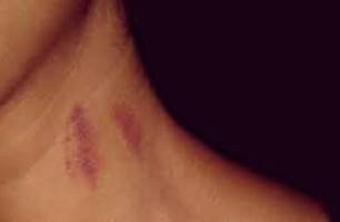 Mulher é diagnosticado com AVC após levar um chupão no pescoço; entenda o caso (Foto: Reprodução)