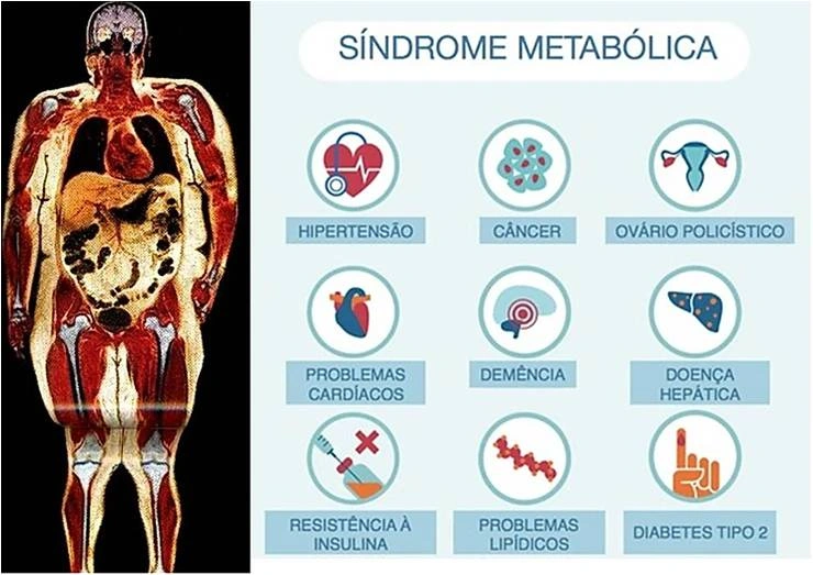 Síndrome Metabólica