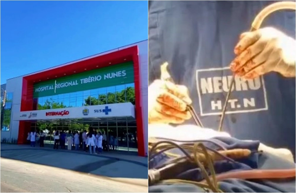 Avanço histórico: Hospital Tibério Nunes realiza a primeira cirurgia de tumor cerebral