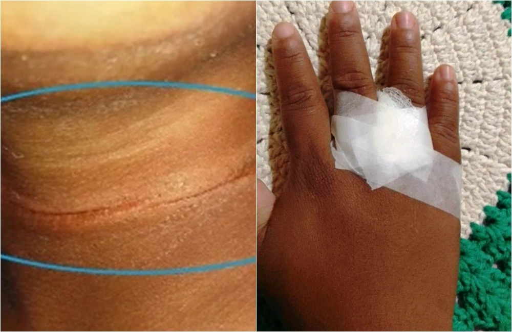 Perigo: criança fica ferida após ser atingida por linha de pipa no Piauí