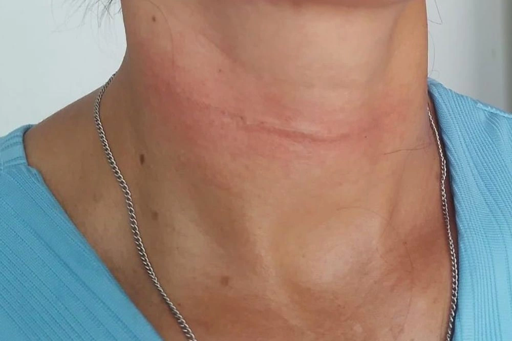 Professora quase é degolada por linha de cerol ao sair para trabalhar em Barras