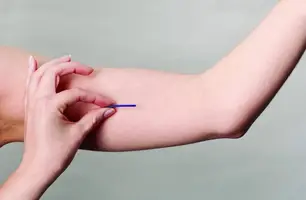 Implanon (Foto: Reprodução/Internet)