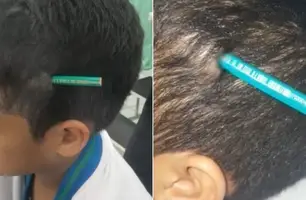 Menino de 9 anos tem lápis cravado na cabeça após agressão em escola de São Paulo (Foto: Reprodução) Menino de 9 anos tem lápis cravado na cabeça após agressão em escola de São Paulo (Foto: Reprodução)